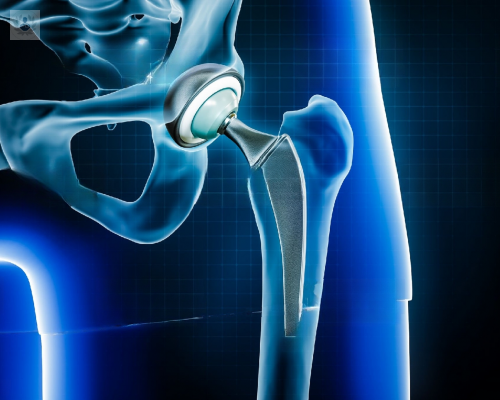 protesis-de-cadera-una-opcion-segura-para-recuperar-tu-movilidad imagen de artículo