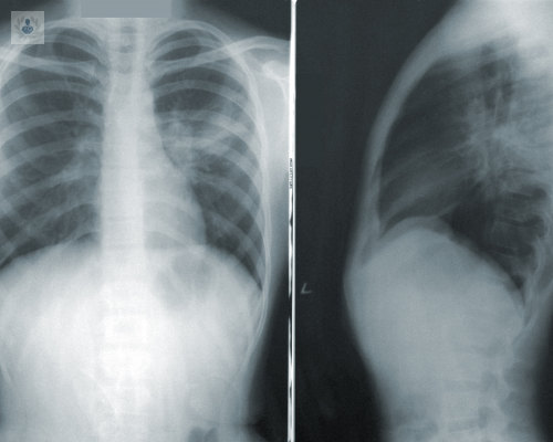 derrame-pleural-maligno-en-que-casos-se-presenta imagen de artículo