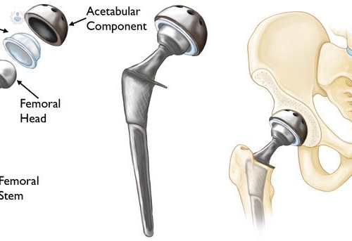 protesis-de-cadera-cirugia-que-mejora-la-calidad-de-vida-del-paciente imagen de artículo