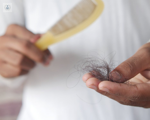 alopecia-androgenica-condicion-que-afecta-al-85-de-hombres imagen de artículo