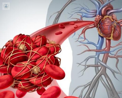 Cardiopatía Pulmonar: afectación del corazón para bombear sangre a los pulmones