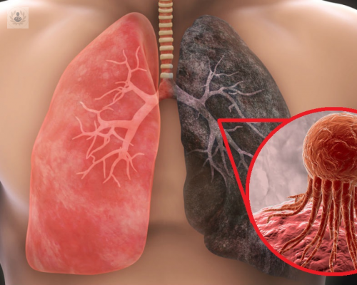 cancer-de-pulmon-sintomas-factores-de-riesgo-y-tratamientos imagen de artículo