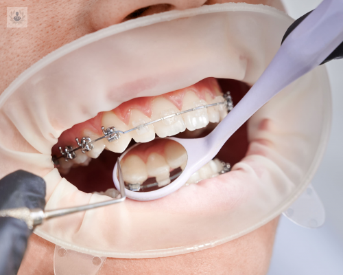 Ortodoncia: tratamientos, ventajas y desventajas