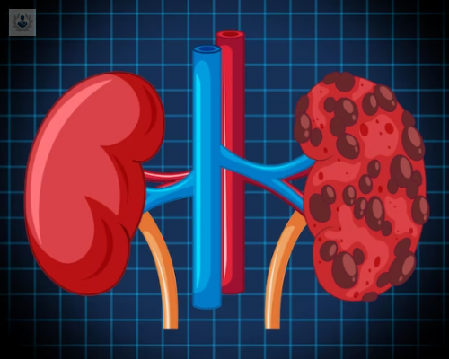 litiasis-renal-conoce-la-mejor-opcion-de-tratamiento imagen de artículo