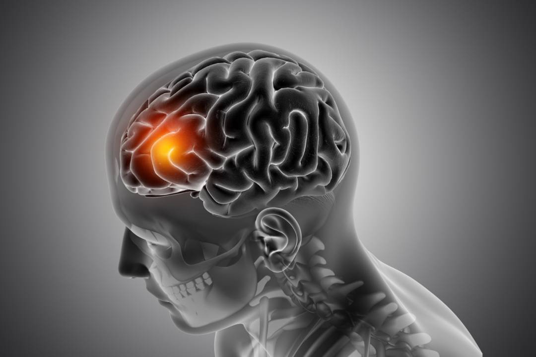 accidente-cerebrovascular-sintomas-causas-pronostico-y-atencion-urgente imagen de artículo