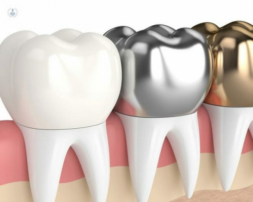 tipos-de-coronas-dentales imagen de artículo