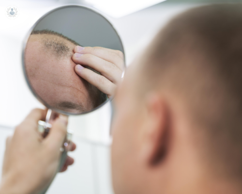alopecia-la-importancia-del-tratamiento-oportuno imagen de artículo
