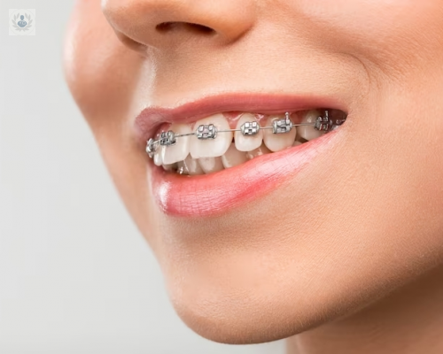 ortodoncia-como-saber-si-somos-candidatos imagen de artículo