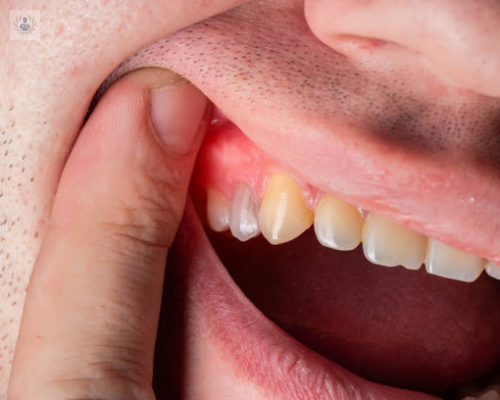 Necrosis Dental: causas, síntomas y tratamiento