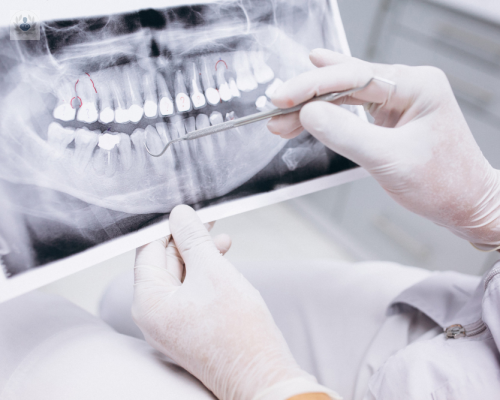 endodoncia-conserva-tus-dientes-infectados-o-en-descomposicion imagen de artículo