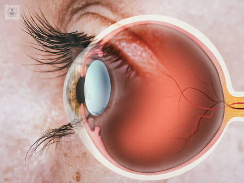 retinopatia-diabetica-la-conexion-entre-la-diabetes-y-la-ceguera imagen de artículo