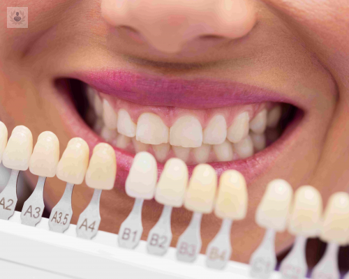 Tipos de Implantes Dentales: Cómo saber cuál es el adecuado para mí 