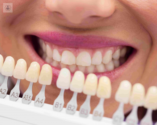 tipos-de-implantes-dentales-como-saber-cual-es-el-adecuado-para-mi imagen de artículo