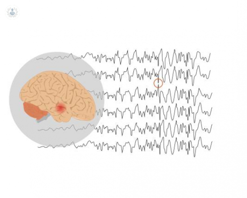 epilepsia-de-lobulo-temporal imagen de artículo