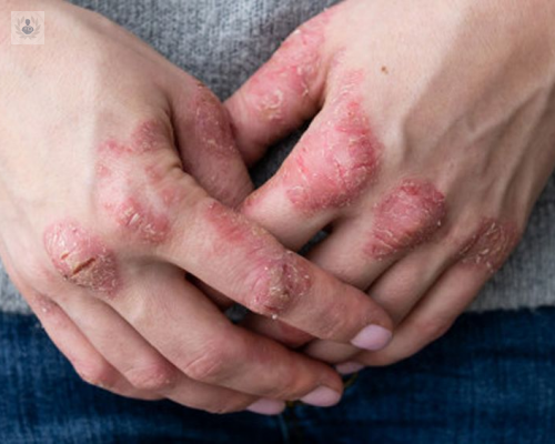 dermatitis-atopica-una-enfermedad-cutanea-comun imagen de artículo