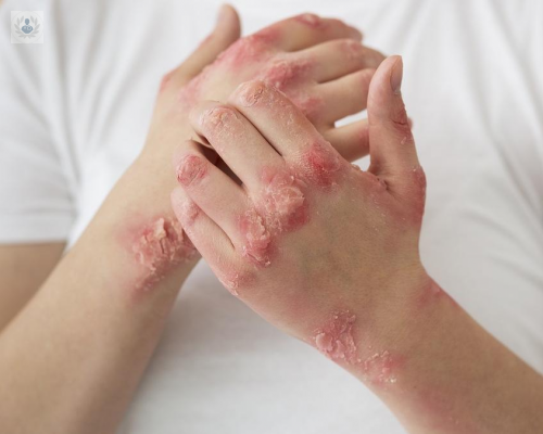 psoriasis-una-enfermedad-cutanea-cronica imagen de artículo