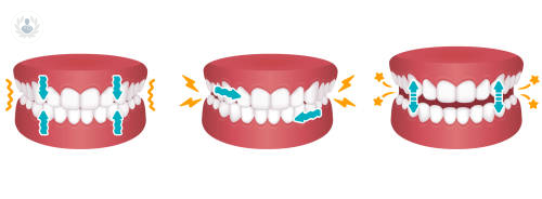 bruxismo-consecuencia-del-estres-en-la-salud-dental-y-maxilofacial imagen de artículo