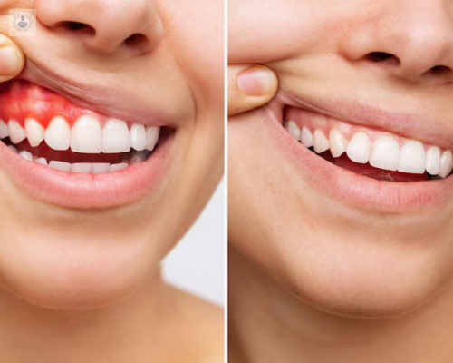 periodontitis-una-infeccion-silenciosa-de-las-encias imagen de artículo
