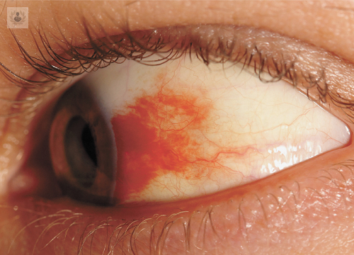 retinopatia-diabetica-lesion-causada-por-la-diabetes-que-puede-llevar-a-la-ceguera imagen de artículo