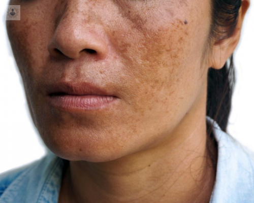 melasma-una-afeccion-cutanea-comun imagen de artículo
