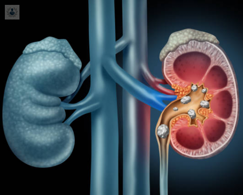 enfermedad-renal-cronica-cuales-son-los-signos-y-sintomas imagen de artículo