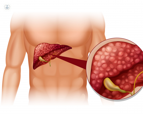 cancer-de-pancreas-la-importancia-de-la-deteccion-en-etapas-tempranas imagen de artículo