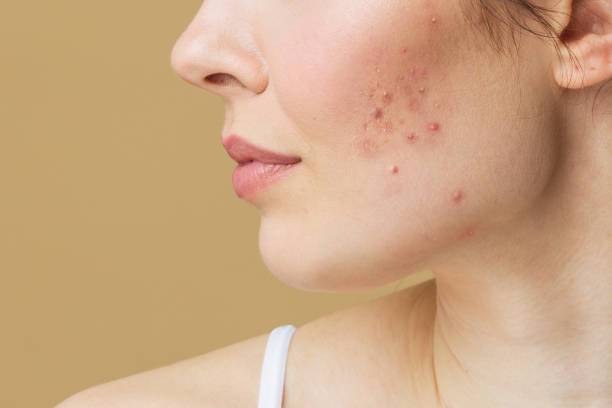 acne-tratamientos-sobre-el-cuidado-de-la-piel imagen de artículo