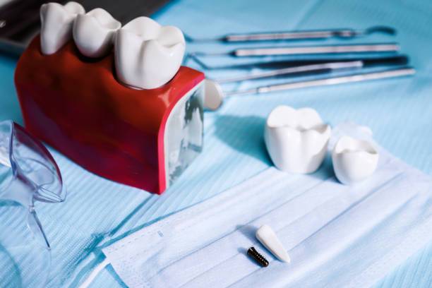 la-importancia-de-la-provision-inmediata-en-implantologia-dental imagen de artículo