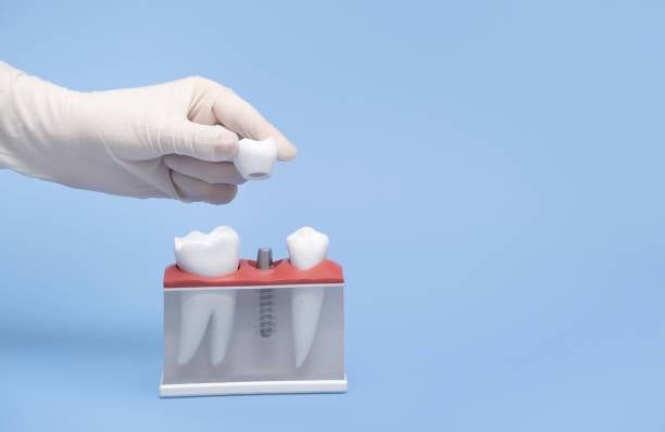 implantes-dentales-procedimiento-consideraciones-y-cuidados imagen de artículo