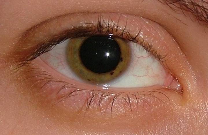 relacion-entre-la-retinopatia-y-la-diabetes-desafios-prevencion-y-avances imagen de artículo