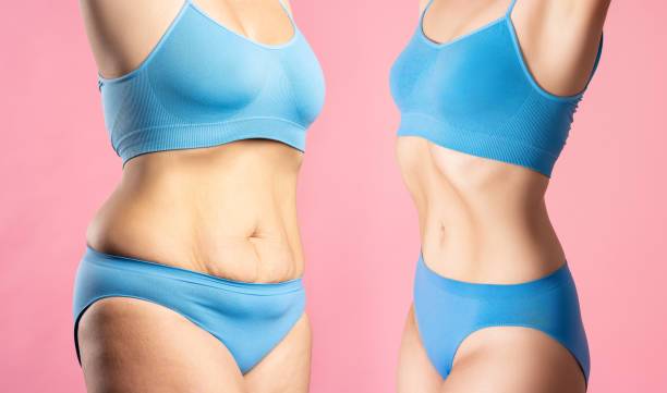 abdominoplastia-recuperando-la-firmeza-del-abdomen imagen de artículo