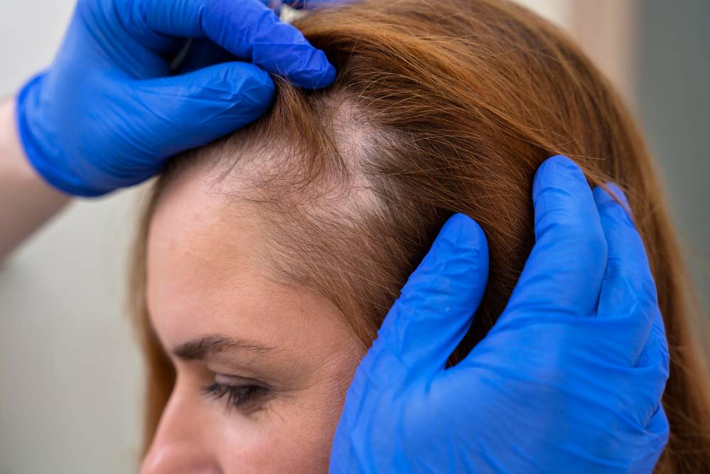 Alopecia: Todo lo que necesitas saber sobre la pérdida de cabello