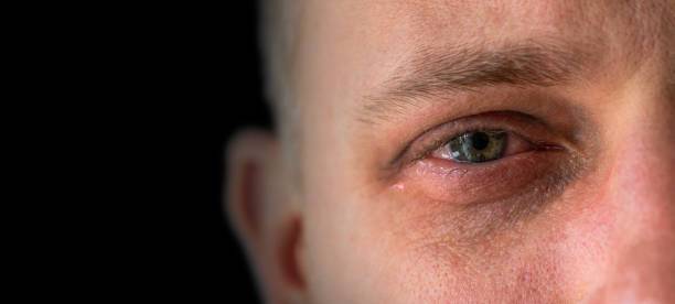 Lagrimeo: Producción excesiva de lágrimas por irritación ocular