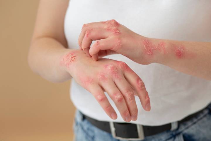 herpes-zoster-opciones-tratamiento-segun-nivel-afectacion imagen de artículo