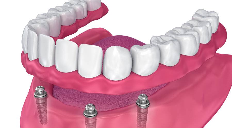 sobredentadura-sobre-implantes-dentales-solucion-innovadora-para-la-perdida-temprana-de-la-dentadura imagen de artículo