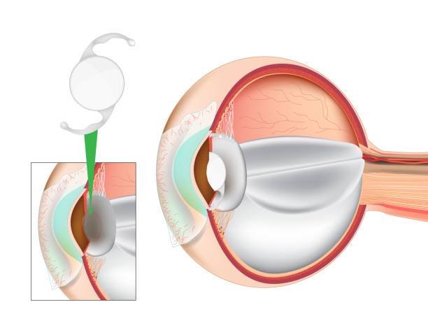 avances-en-la-correccion-visual-lentes-intraoculares-premium imagen de artículo