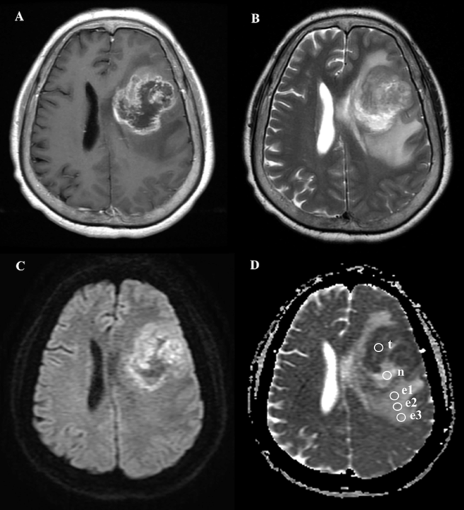 glioblastoma-multiforme-superando-el-cancer-cerebral-mas-agresivo imagen de artículo