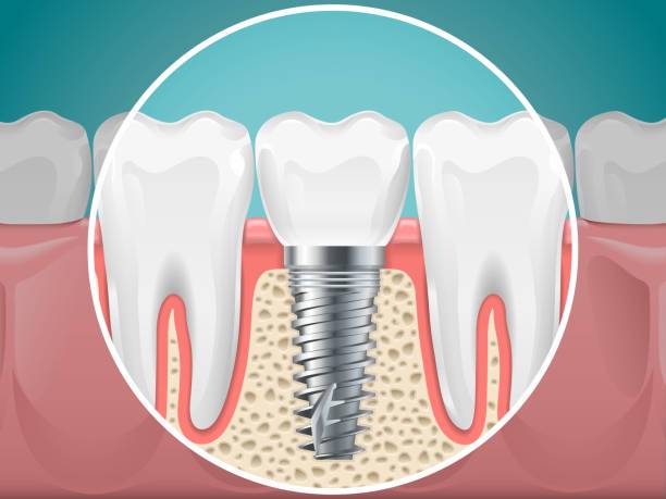 que-son-los-implantes-dentales imagen de artículo