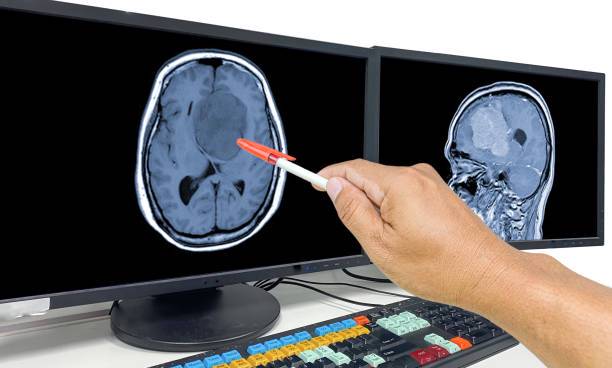 meningiomas-comprension-diagnostico-y-tratamiento-de-estos-tumores-cerebrales-y-medulares imagen de artículo
