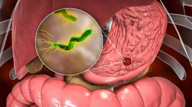 Helicobacter Pylori: La bacteria que está en el radar de la medicina