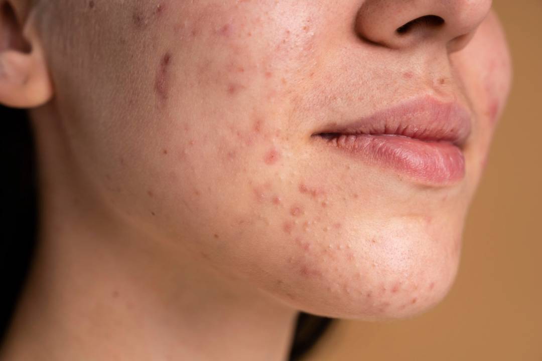 acne-abordaje-y-tratamiento-integral imagen de artículo