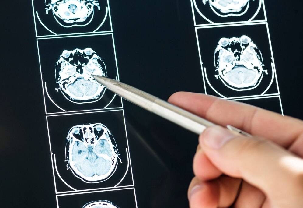 tumores-cerebrales-una-guia-informativa imagen de artículo