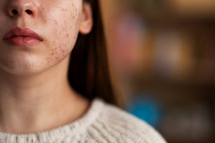 acne-vs-rosacea-diferencias-clave-para-pacientes imagen de artículo