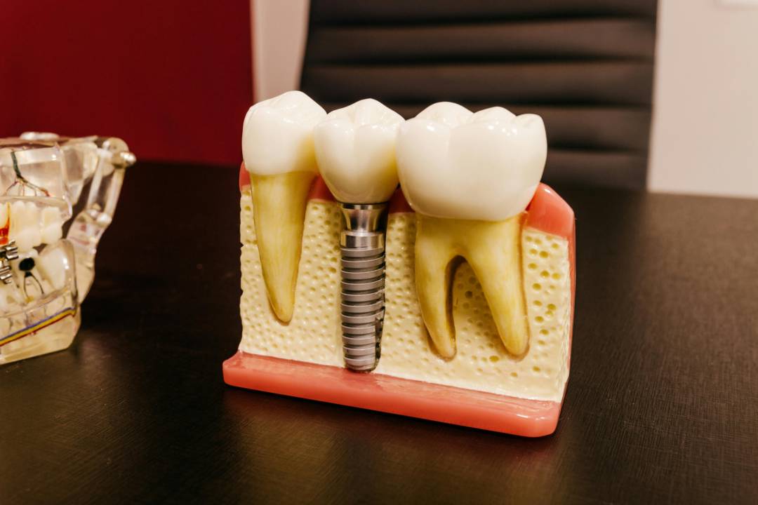 recuperando-la-sonrisa-implantes-dentales-y-su-evolucion imagen de artículo