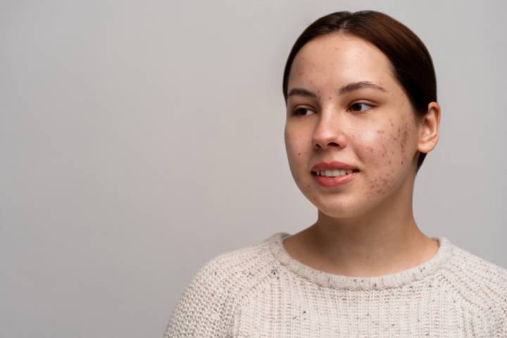 acne-condicion-causa-incomodidad-inseguridad imagen de artículo