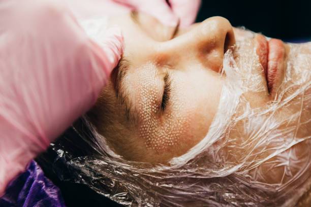 lifting-de-cejas-laser-co-fraccionado-mas-alla-de-la-estetica-facial imagen de artículo