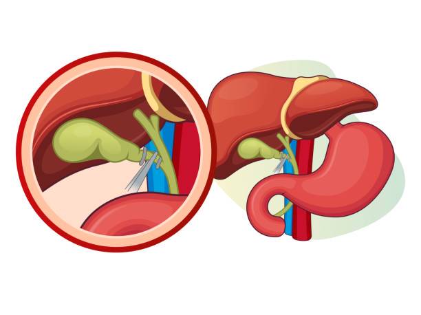 colecistectomia-abordaje-cuidados-postoperatorios imagen de artículo