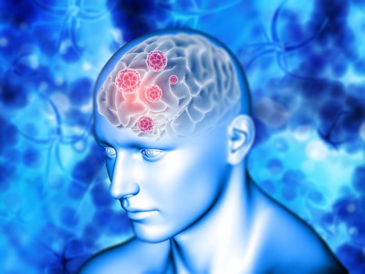 tipos-de-tumores-cerebrales-cuando-preocuparse-que-hacer imagen de artículo