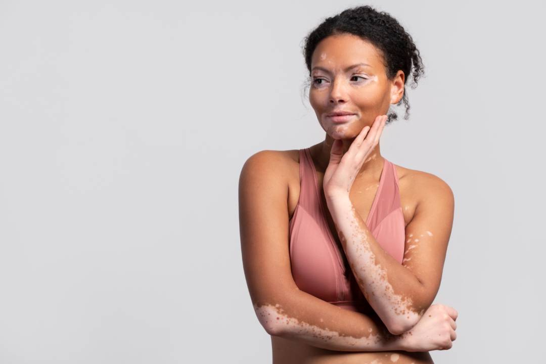 vitiligo-a-quienes-afecta-cuales-son-sus-sintomas-como-tratarlo imagen de artículo