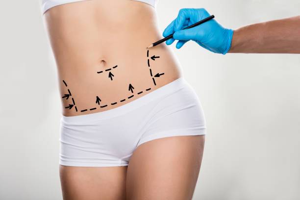 lipoescultura-una-solucion-definitiva-para-contornear-tu-cuerpo imagen de artículo